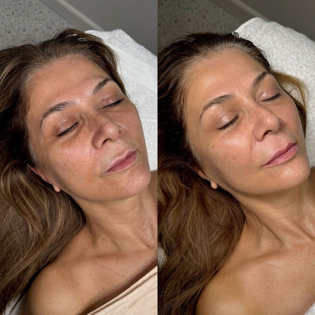 Chemical Peels Results